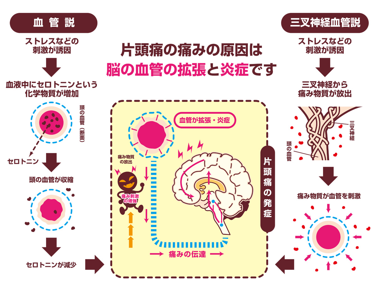 病 頭痛 バセドウ